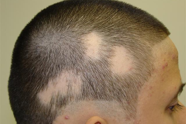 alopecia areata 26022019 1105