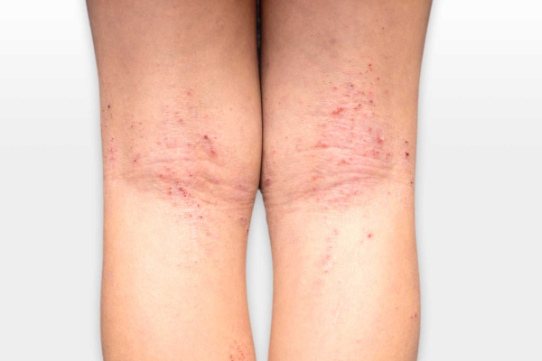 atopic dermatitis 26022019 1107