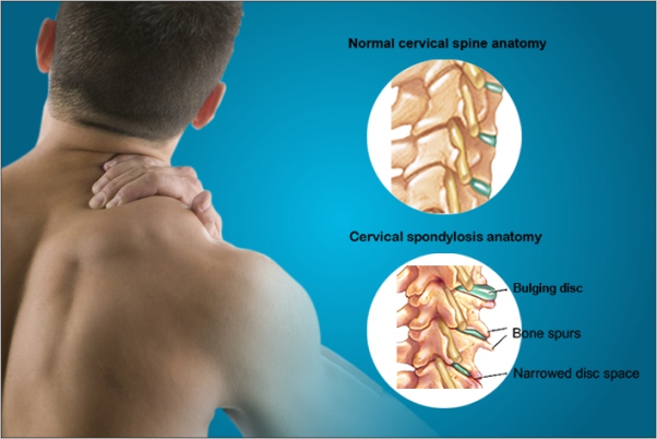 cervical spondylitis 26022019 1107