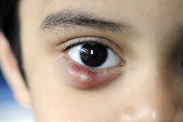 chalazion 08032019 1208