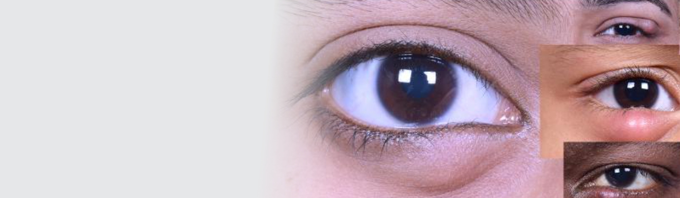 chalazion 09032019 0813