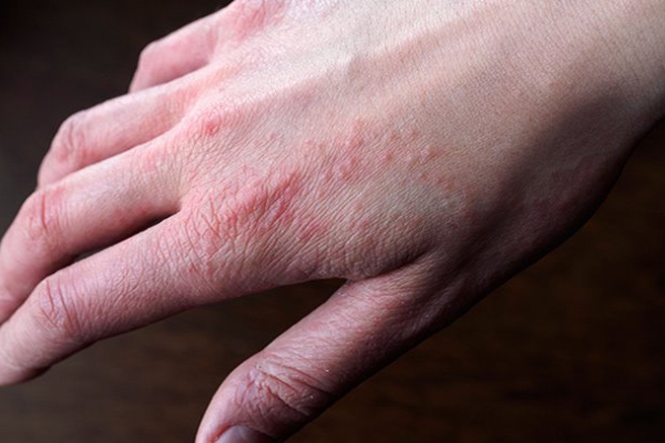 eczema 26022019 1109