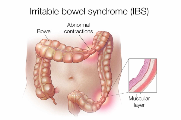 irritable bowel syndrome 26022019 1110