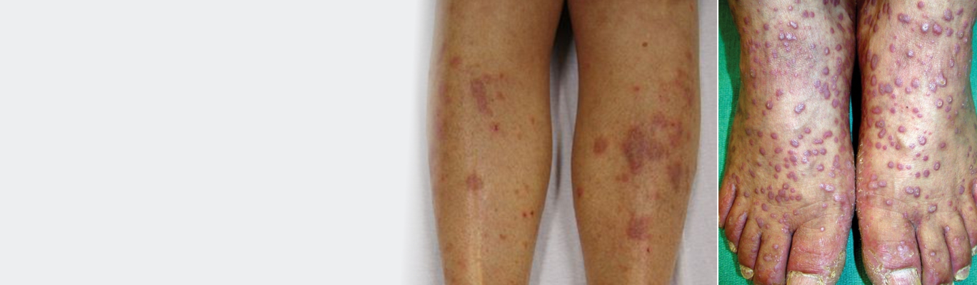 lichen planus 09032019 0959
