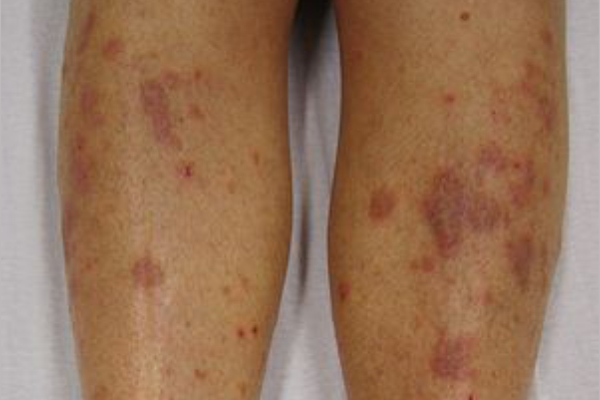 lichen planus 26022019 1111
