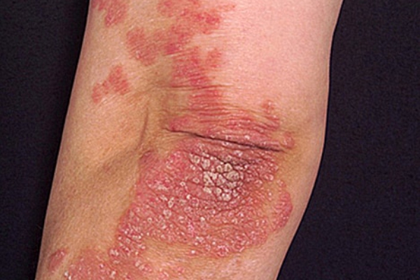 psoriasis 26022019 1112