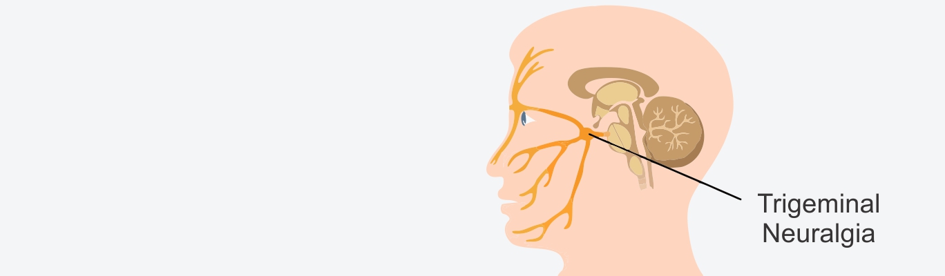 trigeminalneuralgia 09032019 1129