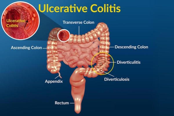 ulcerative colitis 26022019 1113