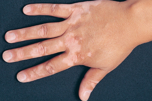 vitiligo 26022019 1113