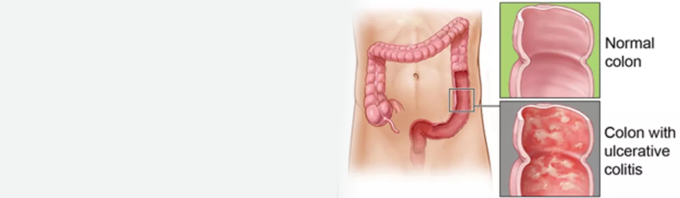 ulcertivecolitis 09032019 1152
